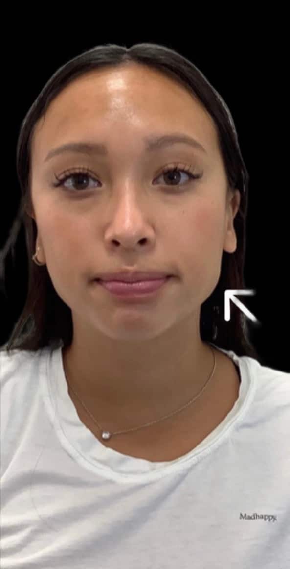 Before Image: Jawline Slimming with Botox - front