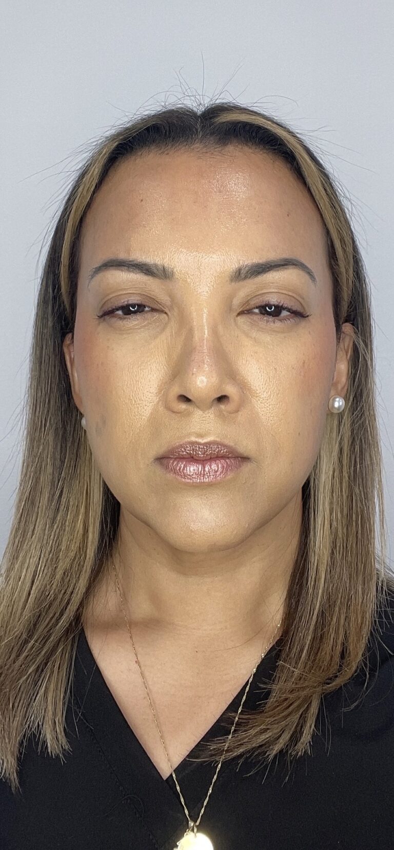 After Image: Botox Full Face -