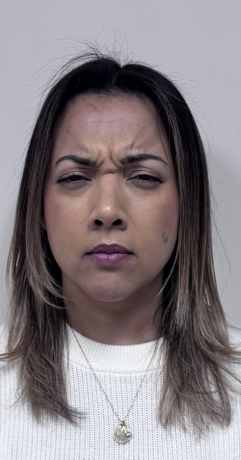 Before Image: Botox Full Face -