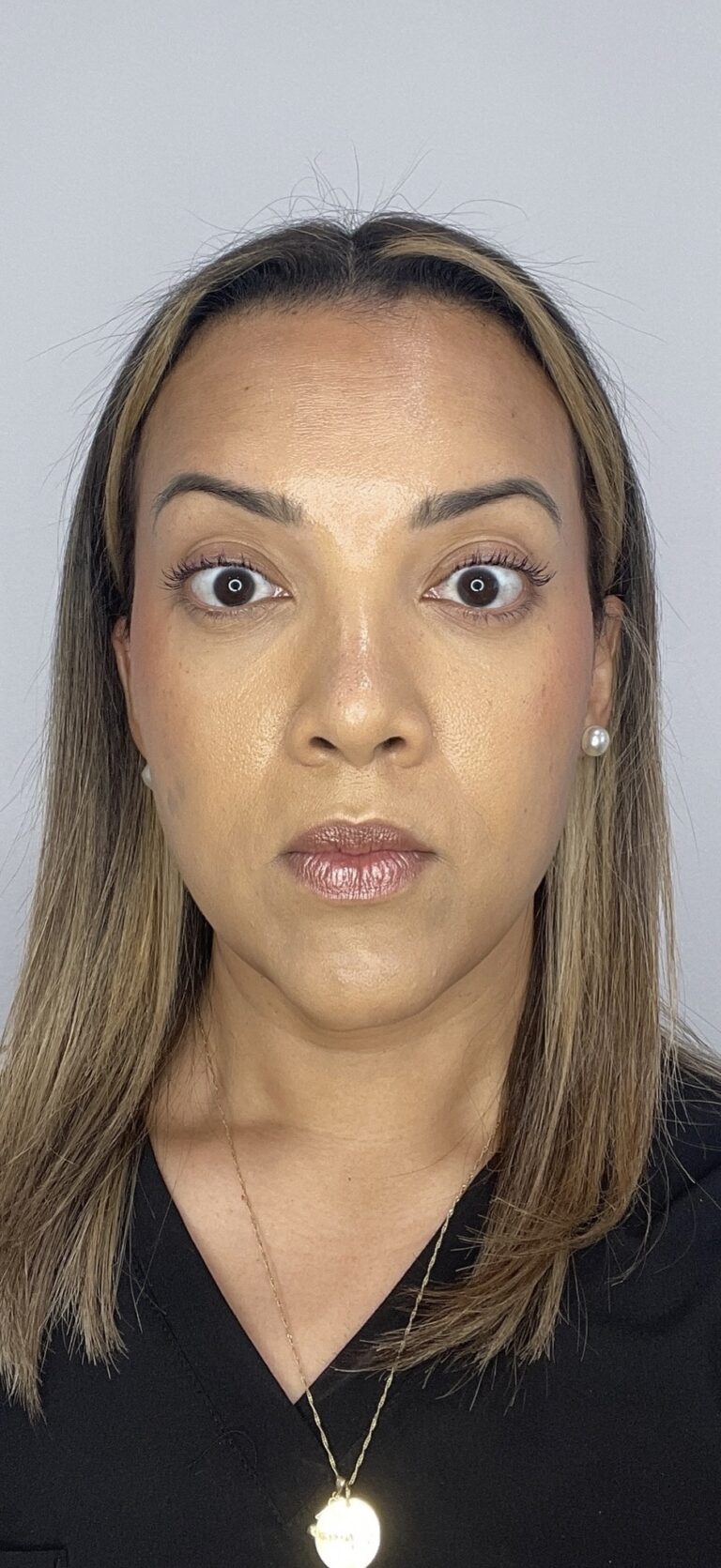 After Image: Botox Full Face -