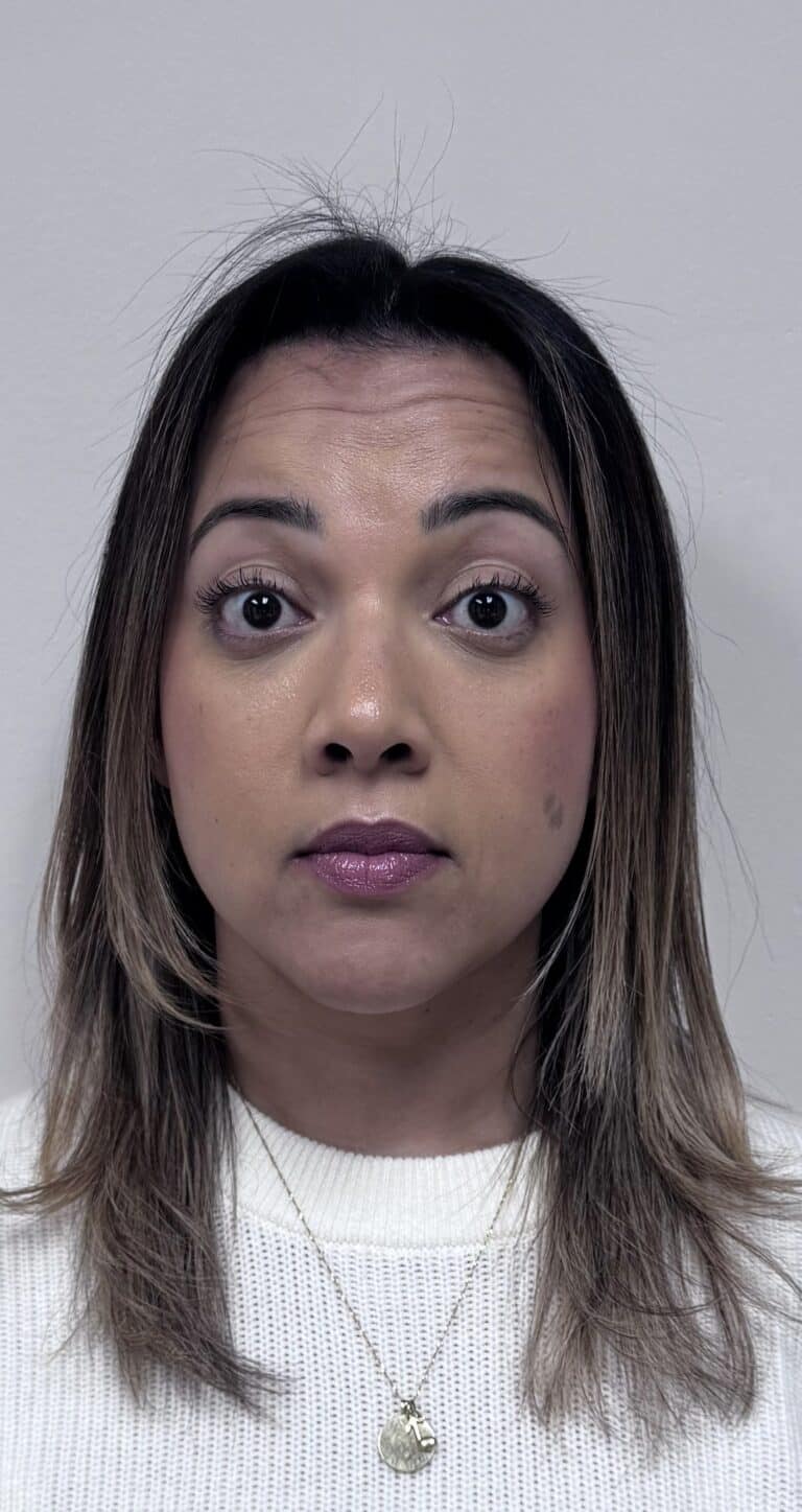 Before Image: Botox Full Face -
