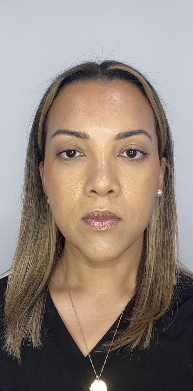 After Image: Botox Full Face -