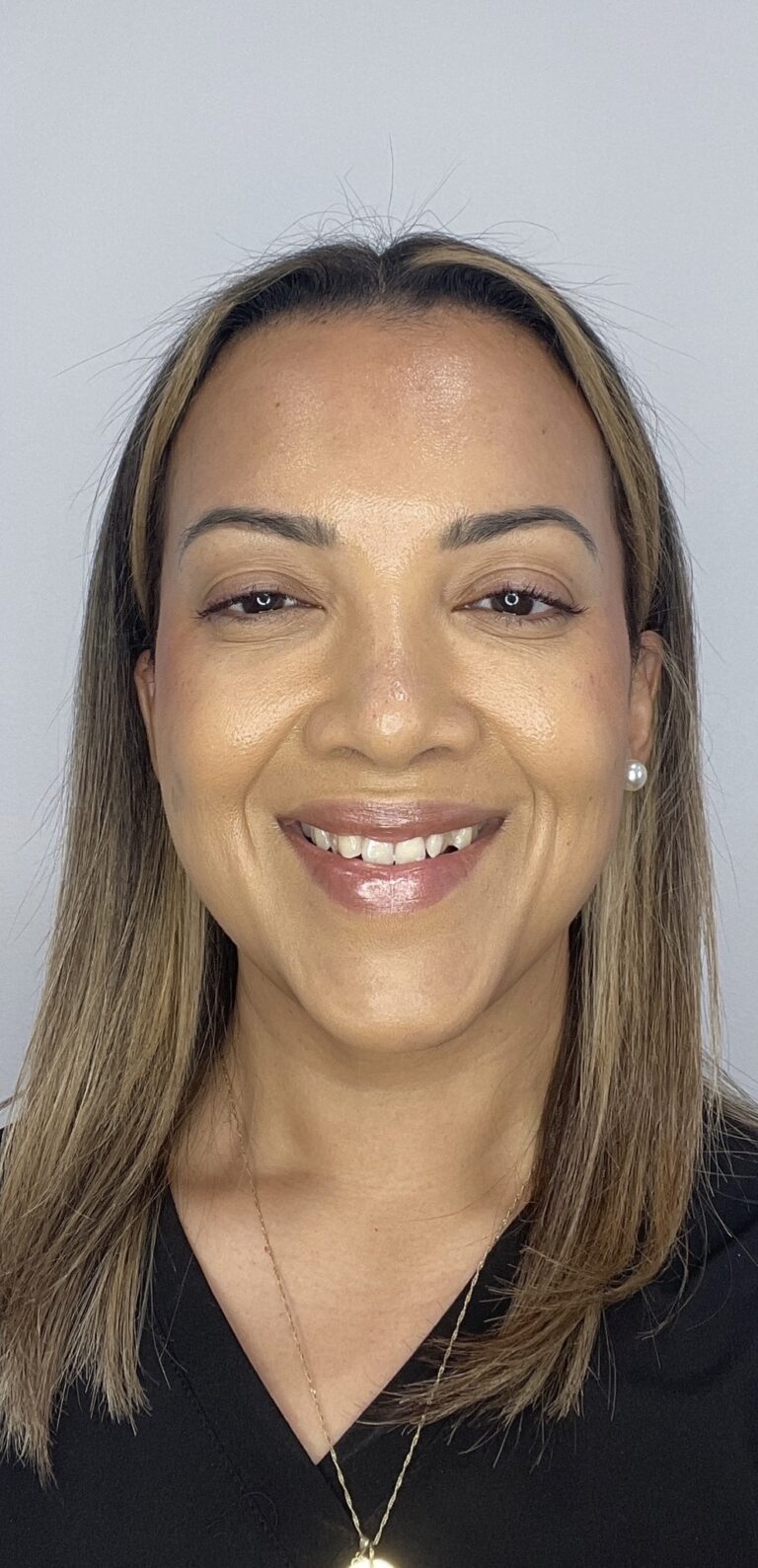 After Image: Botox Full Face -