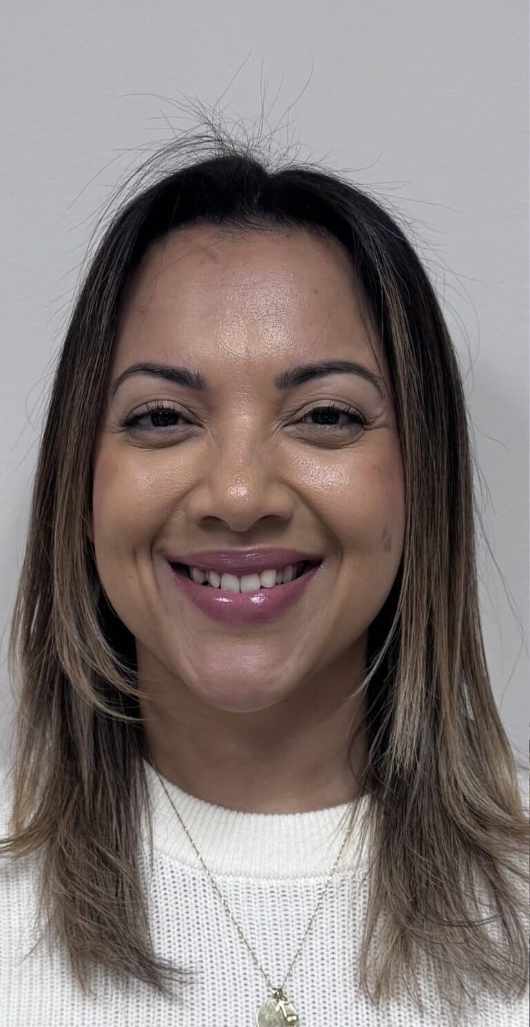 Before Image: Botox Full Face -