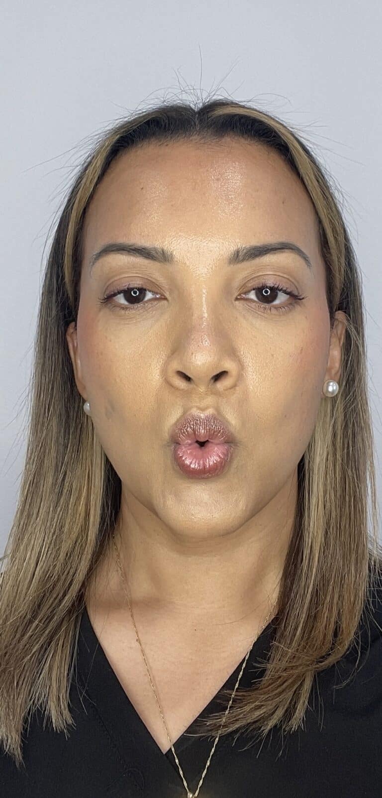 After Image: Botox Full Face -