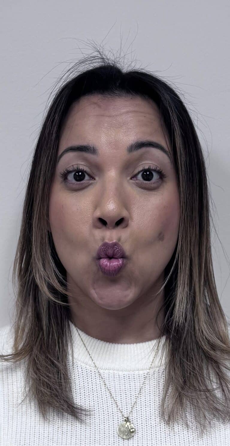 Before Image: Botox Full Face -