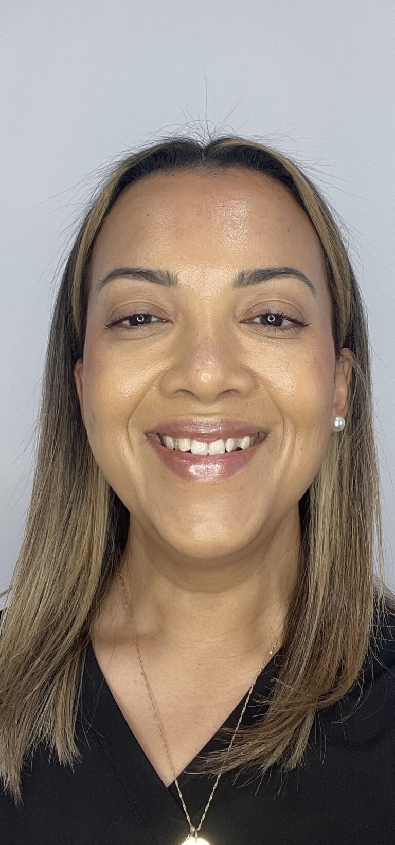 After Image: Botox Full Face -