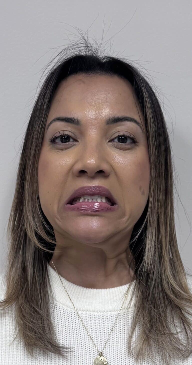 Before Image: Botox Full Face -
