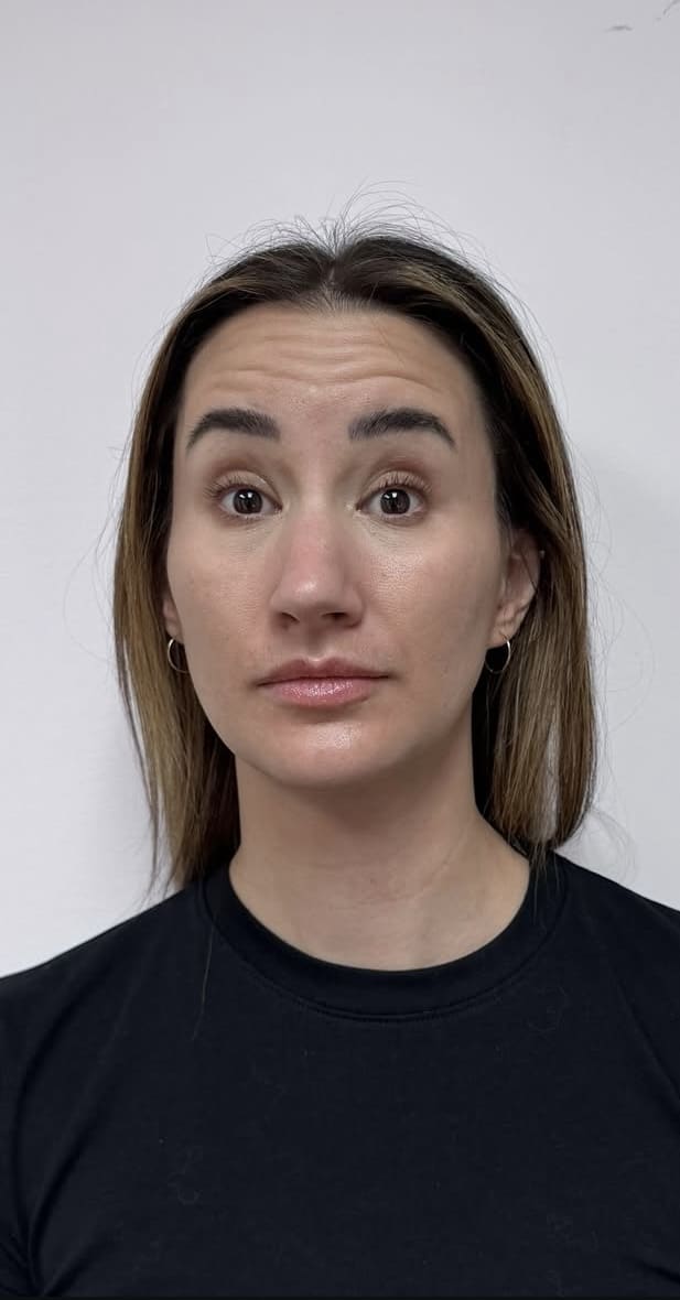 Before Image: Botox Full Face - front